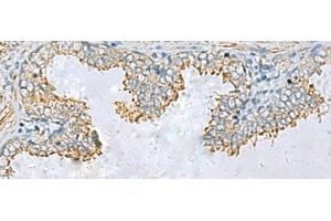 Immunohistochemistry of paraffin-embedded Human prost ate cancer tissue using PLA2G15 Polyclonal Antibody at dilution of 1:65(x200) (PLA2G15 抗体)