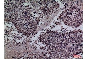 Immunohistochemistry (IHC) analysis of paraffin-embedded Human Lung Cancer, antibody was diluted at 1:100. (Surfactant Protein A1 抗体  (Internal Region))