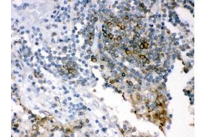 Anti- SHC1 Picoband antibody, IHC(P) IHC(P): Human Lung Cancer Tissue