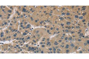 Immunohistochemistry of paraffin-embedded Human liver cancer using CYR61 Polyclonal Antibody at dilution of 1:60 (CYR61 抗体)