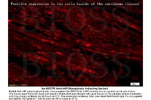 Formalin-fixed and paraffin embedded labeled with human gastric carcinoma Rabbit Anti-AIF Polyclonal Antibody, Unconjugated (ABIN724010) 1:300 followed by conjugation to the secondary antibody Goat Anti-Rabbit IgG, PE (AIF 抗体  (AA 131-230))