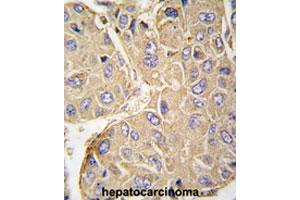 Formalin-fixed and paraffin-embedded human hepatocarcinomareacted with PTPN7 polyclonal antibody , which was peroxidase-conjugated to the secondary antibody, followed by AEC staining. (PTPN7 抗体  (Ser44))
