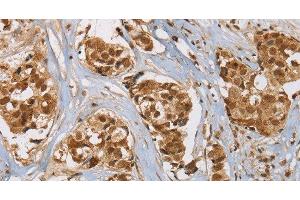 Immunohistochemistry of paraffin-embedded Human breast cancer tissue using RAB24 Polyclonal Antibody at dilution 1:45 (RAB24 抗体)