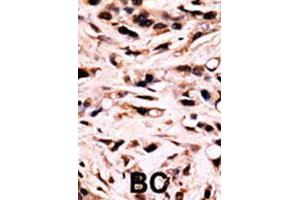 Formalin-fixed and paraffin-embedded human breast cancer tissue reacted with SMAD4 (phospho T277) polyclonal antibody  which was peroxidase-conjugated to the secondary antibody followed by DAB staining. (SMAD4 抗体  (Thr277))