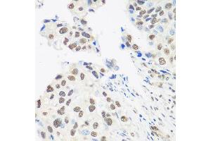 Immunohistochemistry of paraffin-embedded human prostate cancer using DDX39B antibody at dilution of 1:100 (40x lens).