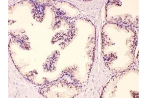 IHC testing of FFPE human prostate cancer tissue with GAA antibody at 1ug/ml. (GAA 抗体  (AA 494-527))