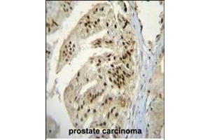 P Antibody (Center) (ABIN655637 and ABIN2845116) immunohistochemistry analysis in formalin fixed and raffin embedded human prostate carcinoma followed by peroxidase conjugation of the secondary antibody and DAB staining.