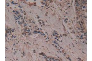 IHC-P analysis of Human Breast Cancer Tissue, with DAB staining. (PTGDS 抗体  (AA 32-190))