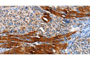 Immunohistochemistry of paraffin-embedded Human liver cancer using AOX1 Polyclonal Antibody at dilution of 1:65 (AOX1 抗体)