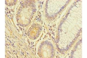 Immunohistochemistry of paraffin-embedded human colon cancer using ABIN7174650 at dilution of 1:100 (ALG14 抗体  (AA 25-216))