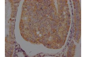 IHC image of ABIN7127366 diluted at 1:100 and staining in paraffin-embedded human endometrial cancer performed on a Leica BondTM system. (Recombinant beta 2 Adrenergic Receptor 抗体)