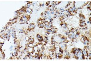 Immunohistochemistry of paraffin-embedded Human thyroid cancer using NUBP1 Polyclonal Antibody at dilution of 1:100 (40x lens). (NUBP1 抗体)