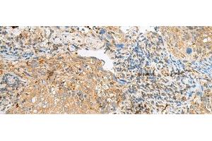 Immunohistochemistry of paraffin-embedded Human cervical cancer tissue using COPE Polyclonal Antibody at dilution of 1:50(x200) (COPE 抗体)