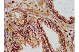 IHC image of ABIN7157591 diluted at 1:400 and staining in paraffin-embedded human prostate cancer performed on a Leica BondTM system. (KIF13B 抗体  (AA 1531-1701))