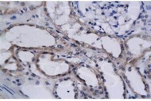 Formalin-fixed and paraffin embedded human kidney cancer labeled with Anti-HIF-2? (EPAS1 抗体  (AA 1-130))