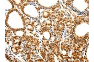 The image on the left is immunohistochemistry of paraffin-embedded Human thyroid cancer tissue using ABIN7128859(CDH23 Antibody) at dilution 1/80, on the right is treated with fusion protein. (CDH23 抗体)