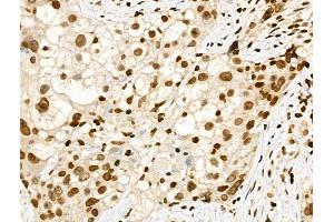 Phospho-SMC1 (Ser957) Antibody at 1/100 staining Human ovarian cancer by IHC-P. (SMC1A 抗体  (pSer957))
