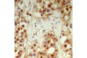 Immunohistochemical analysis of NXF3 staining in human breast cancer formalin fixed paraffin embedded tissue section.