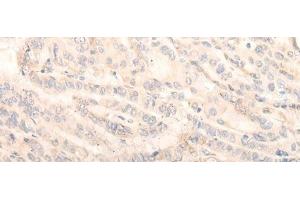 Immunohistochemistry of paraffin-embedded Human thyroid cancer tissue using INPP1 Polyclonal Antibody at dilution of 1:35(x200) (INPP1 抗体)