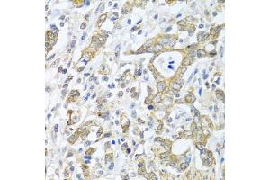Immunohistochemistry of paraffin-embedded human gastric cancer using TICAM1 antibody (ABIN6292306) at dilution of 1:100 (40x lens). (TICAM1 抗体)