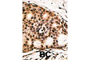 Formalin-fixed and paraffin-embedded human cancer tissue reacted with CDX1 polyclonal antibody  , which was peroxidase-conjugated to the secondary antibody, followed by AEC staining. (CDX1 抗体  (C-Term))