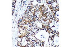 Immunohistochemistry of paraffin-embedded Human colon carcinoma using GULP1 Rabbit pAb (ABIN6131564, ABIN6141541, ABIN6141542 and ABIN6220256) at dilution of 1:100 (40x lens). (GULP1 抗体  (AA 1-130))