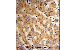 Formalin-fixed and paraffin-embedded human hepatocarcinoma reacted with HYOU1 Antibody (Center), which was peroxidase-conjugated to the secondary antibody, followed by DAB staining. (HYOU1 抗体  (AA 274-303))