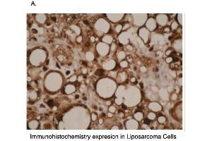 Immunohistochemical staining of human liposarcoma cells using CYP4F11 antibody . (CYP4F11 抗体  (C-Term))