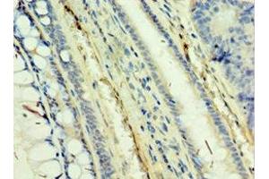 Immunohistochemistry of paraffin-embedded human colon cancer using ABIN7171470 at dilution of 1:100 (TAF5L 抗体  (AA 1-325))
