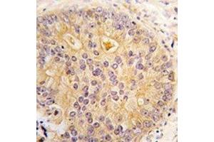IHC analysis of FFPE human prostate carcinoma tissue stained with CAMKK2 antibody (CAMKK2 抗体  (AA 52-82))