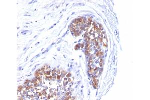 Formalin-fixed, paraffin-embedded human Breast Carcinoma stained with MUC-1 / EMA Mouse Monoclonal Antibody (MUC1/520). (MUC1 抗体)