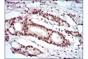 Immunohistochemical analysis of paraffin-embedded colon cancer tissues using KHDRBS2 mouse mAb with DAB staining. (KHDRBS2 抗体  (AA 160-349))