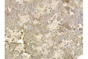 ABIN6259222 and ABIN6274419 at 1/100 staining human melanoma by IHC-P. (TRIM59 抗体  (Internal Region))