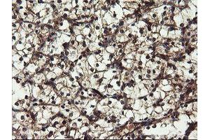 Immunohistochemical staining of paraffin-embedded Carcinoma of Human kidney tissue using anti-DOK7 mouse monoclonal antibody. (DOK7 抗体)