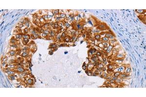 Immunohistochemistry of paraffin-embedded Human cervical cancer using CK-13 Polyclonal Antibody at dilution of 1:35 (Cytokeratin 13 抗体)