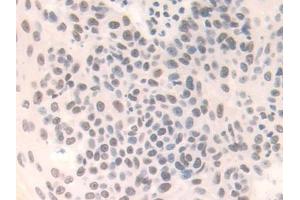 Detection of FAM19A3 in Human Skin cancer Tissue using Polyclonal Antibody to Family With Sequence Similarity 19, Member A3 (FAM19A3)