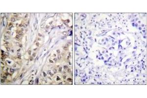 Immunohistochemistry analysis of paraffin-embedded human breast carcinoma tissue, using Survivin (Ab-117) Antibody. (Survivin 抗体  (AA 86-135))
