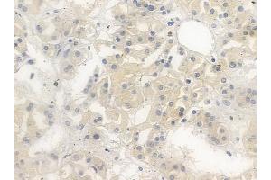ABIN6255276 and ABIN6267247 at 1/100 staining human renal cell carcinoma by IHC-P.
