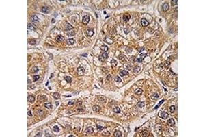 IHC analysis of FFPE human hepatocarcinoma tissue stained with AKR1A1 antibody