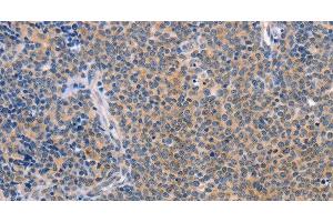 Immunohistochemistry of paraffin-embedded Human Lymphoma using CCL16 Polyclonal Antibody at dilution of 1:50 (CCL16 抗体)