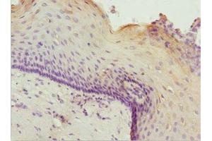 Immunohistochemistry of paraffin-embedded human cervical cancer using ABIN7176007 at dilution of 1:100 (ZNF187 抗体  (AA 239-478))