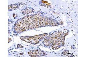 IHC analysis of Thymidylate Synthase/TYMS using anti-Thymidylate Synthase/TYMS antibody (ABIN7599260).