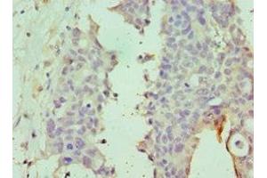 Immunohistochemistry of paraffin-embedded human endometrial cancer using ABIN7149988 at dilution of 1:100 (DPP8 抗体  (AA 10-230))