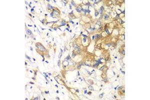 Immunohistochemistry of paraffin-embedded human liver cancer using KLK10 antibody at dilution of 1:100 (40x lens). (Kallikrein 10 抗体)