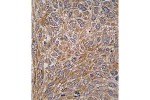 Formalin-fixed and paraffin-embedded human lung carcinoma tissue reacted with GIT1 Antibody  (ABIN391615 and ABIN2841536) , which was peroxidase-conjugated to the secondary antibody, followed by DAB staining. (GIT1 抗体  (AA 487-517))