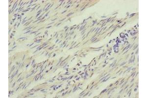 Immunohistochemistry of paraffin-embedded human bladder cancer using ABIN7156905 at dilution of 1:100 (IL1F9 抗体  (AA 1-169))