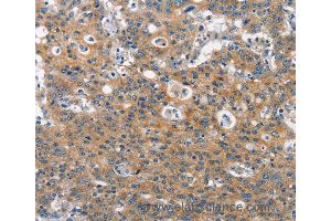 Immunohistochemistry of Human gastric cancer using CLTC Polyclonal Antibody at dilution of 1:60 (Clathrin Heavy Chain (CLTC) 抗体)
