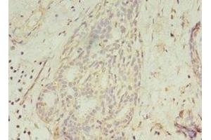 Immunohistochemistry of paraffin-embedded human breast cancer using ABIN7154452 at dilution of 1:100 (GCC1 抗体  (AA 4-775))