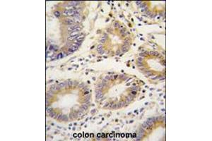 Formalin-fixed and paraffin-embedded human colon carcinoma tissue reacted with LEFTB antibody , which was peroxidase-conjugated to the secondary antibody, followed by DAB staining. (LEFTY1 抗体  (C-Term))