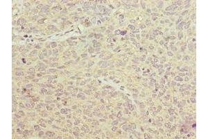 Immunohistochemistry of paraffin-embedded human cervical cancer using ABIN7153904 at dilution of 1:100 (PGM2L1 抗体  (AA 101-400))